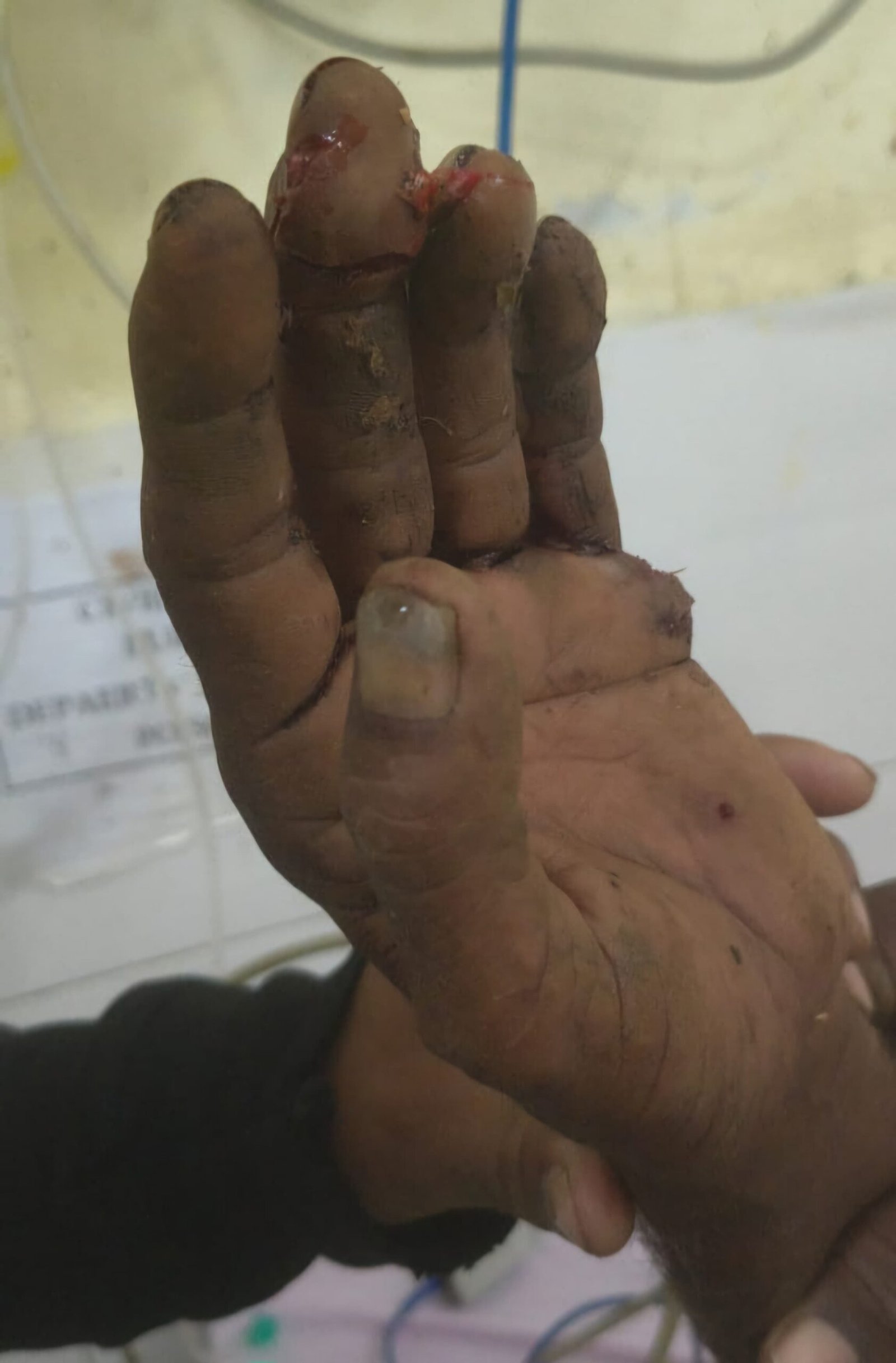 धोडपच्या शेतकऱ्यावर अस्वलाचा हल्ला!