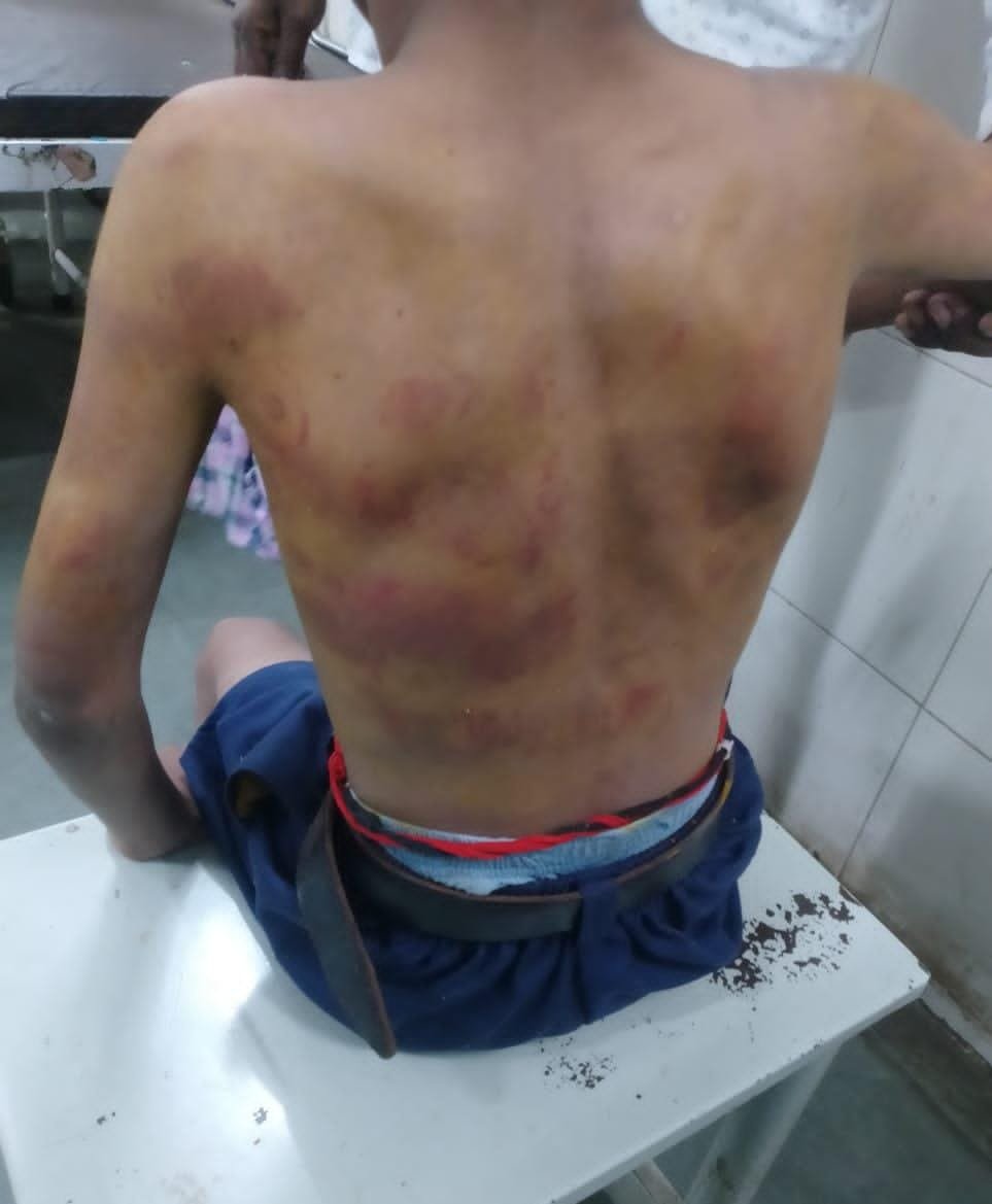 खामगाव ब्रेकिंग: शिक्षकाकडून विद्यार्थ्याला अमानुष मारहाण